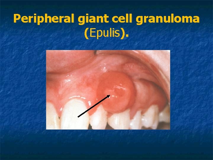 Peripheral giant cell granuloma (Epulis). Peripheral giant cell granuloma (Epulis).