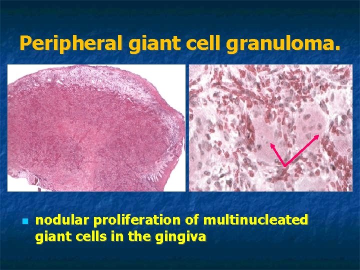 Peripheral giant cell granuloma. nodular proliferation of multinucleated giant cells in the gingiva Peripheral giant cell granuloma. nodular proliferation of multinucleated giant cells in the gingiva