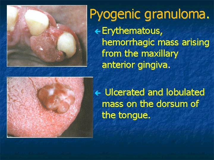 Pyogenic granuloma. Erythematous, hemorrhagic mass arising from the maxillary anterior gingiva. Ulcerated and lobulated Pyogenic granuloma. Erythematous, hemorrhagic mass arising from the maxillary anterior gingiva. Ulcerated and lobulated