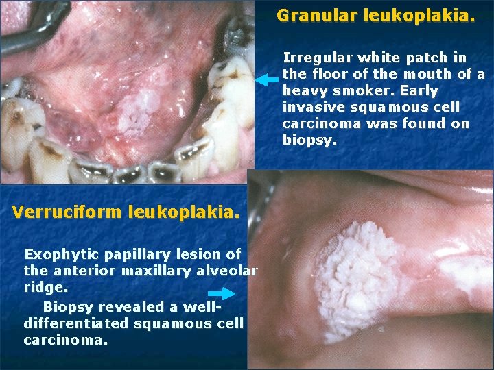 Granular leukoplakia. Irregular white patch in the floor of the mouth of a heavy Granular leukoplakia. Irregular white patch in the floor of the mouth of a heavy