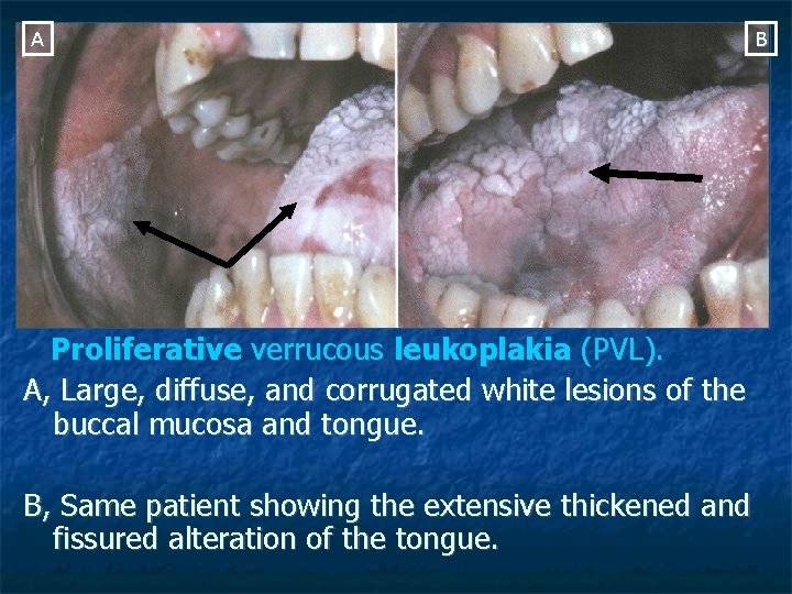 A Proliferative verrucous leukoplakia (PVL). A, Large, diffuse, and corrugated white lesions of the A Proliferative verrucous leukoplakia (PVL). A, Large, diffuse, and corrugated white lesions of the