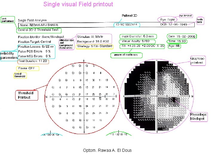 Metode de determinare a câmpului vizual folosind un perimetru de calculator - Lentile 