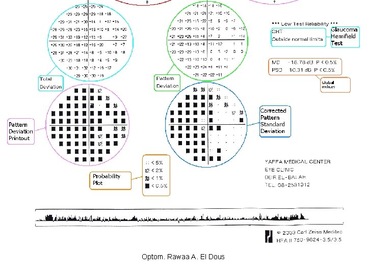 Optom. Rawaa A. El Dous 