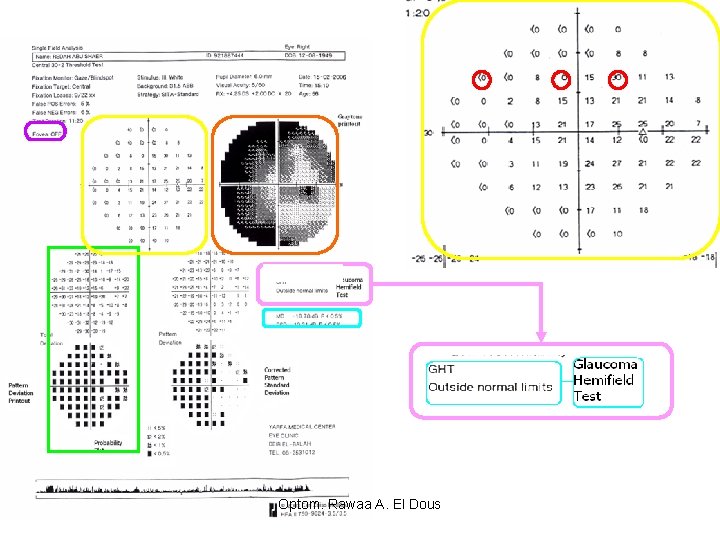 Optom. Rawaa A. El Dous 