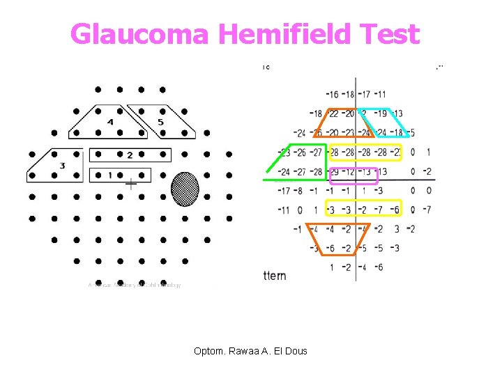 Glaucoma Hemifield Test Optom. Rawaa A. El Dous 