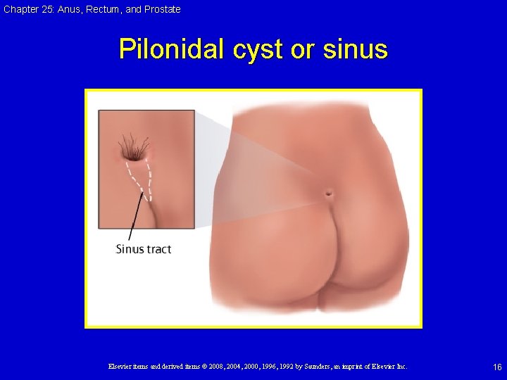 Chapter 25: Anus, Rectum, and Prostate Pilonidal cyst or sinus Elsevier items and derived Chapter 25: Anus, Rectum, and Prostate Pilonidal cyst or sinus Elsevier items and derived
