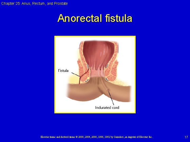 Chapter 25: Anus, Rectum, and Prostate Anorectal fistula Elsevier items and derived items © Chapter 25: Anus, Rectum, and Prostate Anorectal fistula Elsevier items and derived items ©