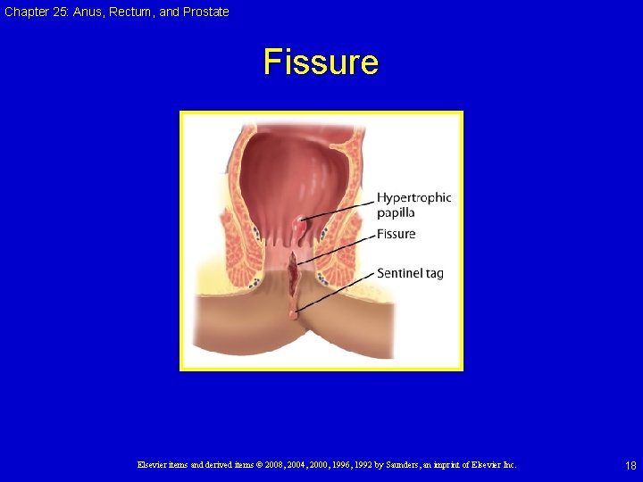 Chapter 25: Anus, Rectum, and Prostate Fissure Elsevier items and derived items © 2008, Chapter 25: Anus, Rectum, and Prostate Fissure Elsevier items and derived items © 2008,
