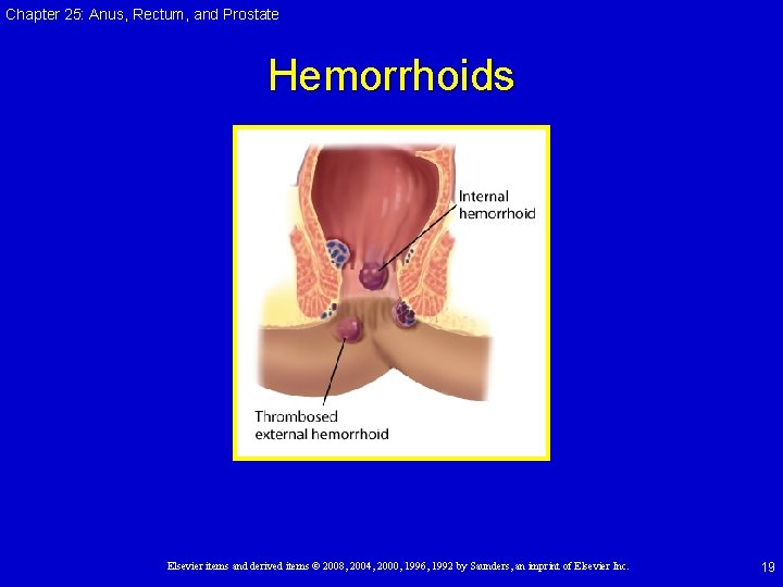 Chapter 25: Anus, Rectum, and Prostate Hemorrhoids Elsevier items and derived items © 2008, Chapter 25: Anus, Rectum, and Prostate Hemorrhoids Elsevier items and derived items © 2008,