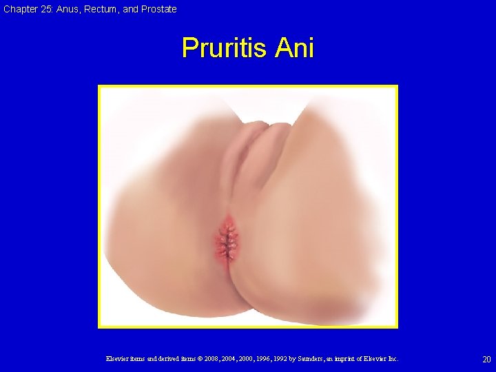 Chapter 25: Anus, Rectum, and Prostate Pruritis Ani Elsevier items and derived items © Chapter 25: Anus, Rectum, and Prostate Pruritis Ani Elsevier items and derived items ©