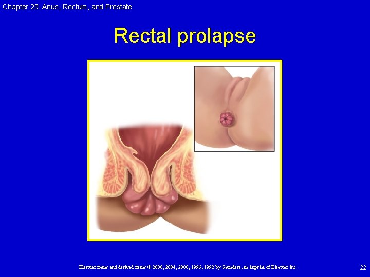 Chapter 25: Anus, Rectum, and Prostate Rectal prolapse Elsevier items and derived items © Chapter 25: Anus, Rectum, and Prostate Rectal prolapse Elsevier items and derived items ©