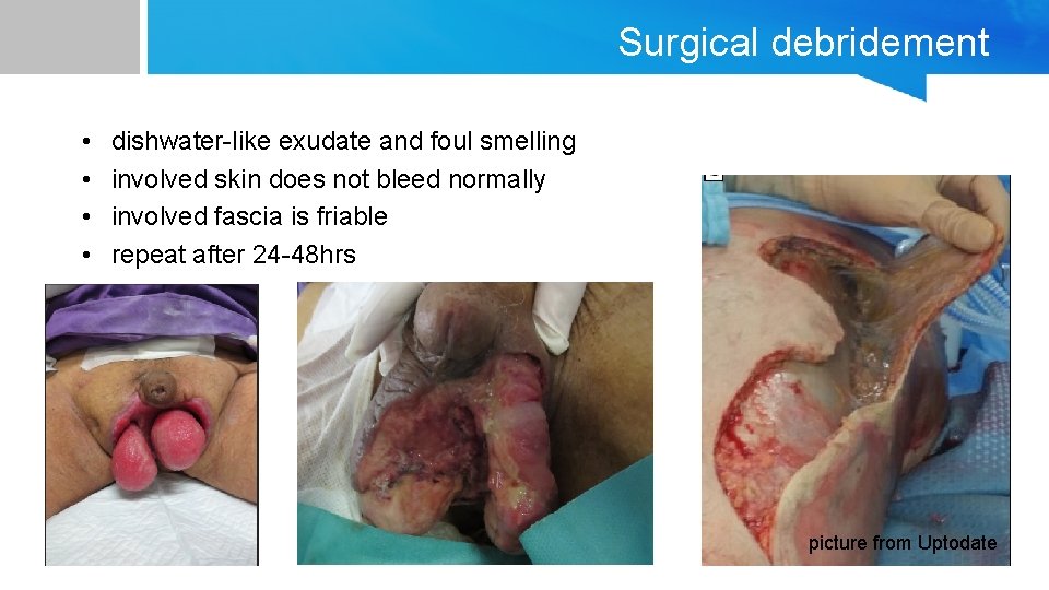 Surgical debridement • • dishwater-like exudate and foul smelling involved skin does not bleed