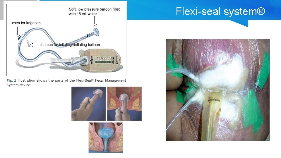 Flexi-seal system® 