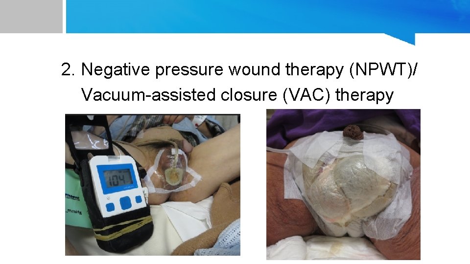 2. Negative pressure wound therapy (NPWT)/ Vacuum-assisted closure (VAC) therapy 