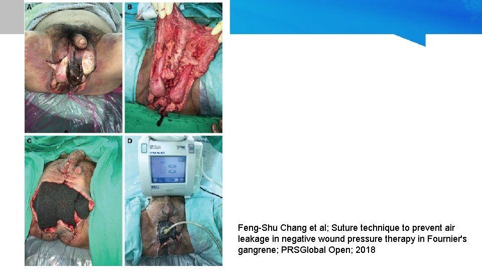Feng-Shu Chang et al; Suture technique to prevent air leakage in negative wound pressure