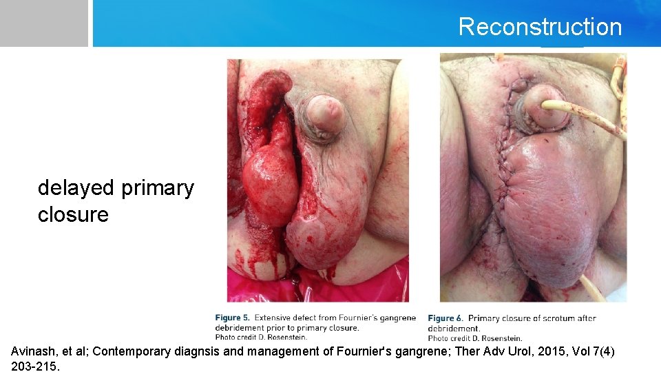 Reconstruction delayed primary closure Avinash, et al; Contemporary diagnsis and management of Fournier's gangrene;