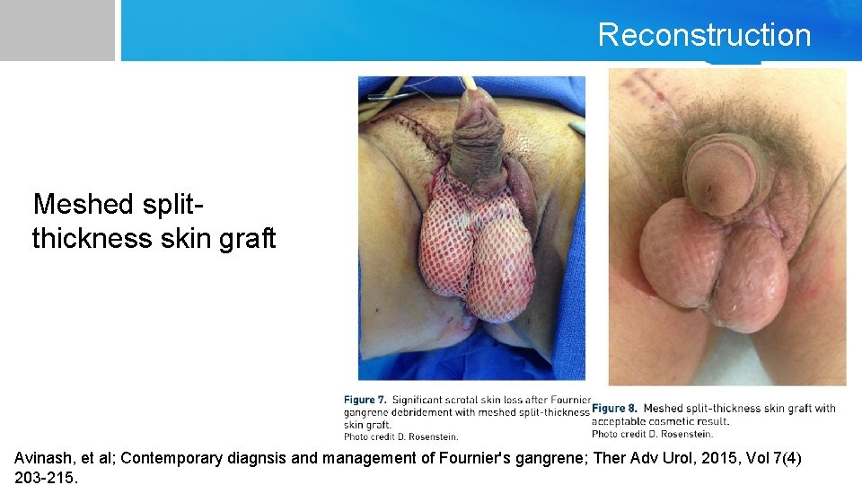 Reconstruction Meshed splitthickness skin graft Avinash, et al; Contemporary diagnsis and management of Fournier's