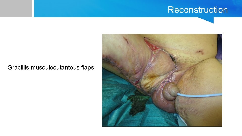 Reconstruction Gracillis musculocutantous flaps 