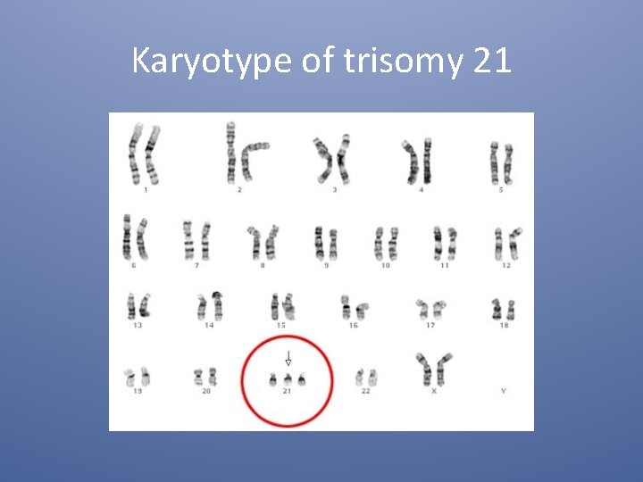 Karyotype of trisomy 21 