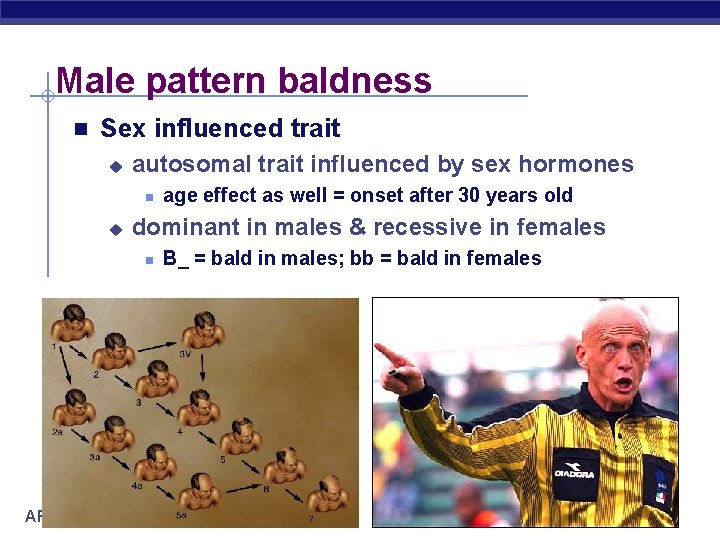 Male pattern baldness n Sex influenced trait u autosomal trait influenced by sex hormones