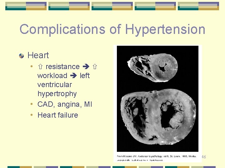 Complications of Hypertension Heart • resistance workload left ventricular hypertrophy • CAD, angina, MI