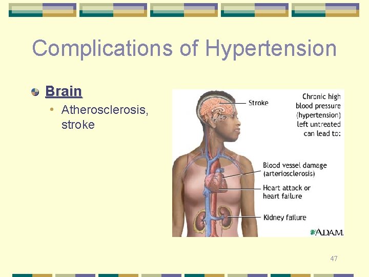 Complications of Hypertension Brain • Atherosclerosis, stroke 47 