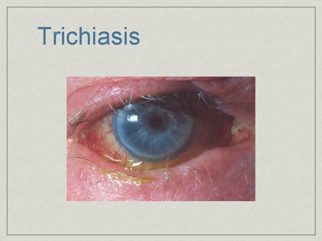 Trichiasis 