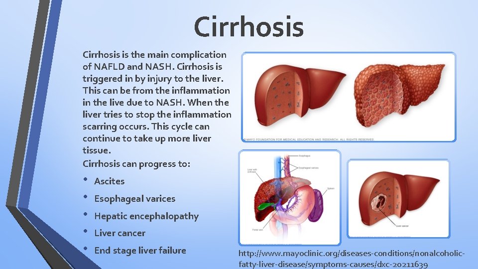 Cirrhosis is the main complication of NAFLD and NASH. Cirrhosis is triggered in by