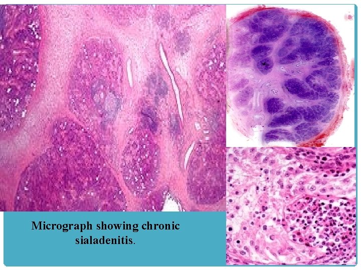 Micrograph showing chronic sialadenitis. 