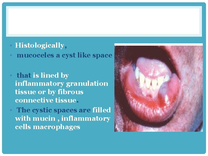  • Histologically, • mucoceles a cyst like space • that is lined by