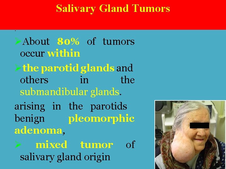 Salivary Gland Tumors. ØAbout 80% of tumors occur within Øthe parotid glands and others