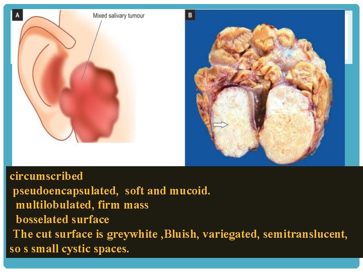 circumscribed pseudoencapsulated, soft and mucoid. multilobulated, firm mass bosselated surface The cut surface is