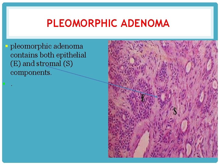 PLEOMORPHIC ADENOMA § pleomorphic adenoma contains both epithelial (E) and stromal (S) components. §.