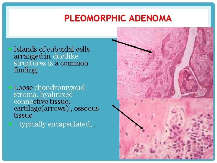 PLEOMORPHIC ADENOMA § Islands of cuboidal cells arranged in ductlike structures is a common