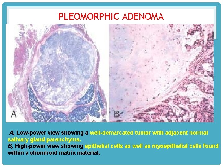 PLEOMORPHIC ADENOMA A, Low-power view showing a well-demarcated tumor with adjacent normal salivary gland