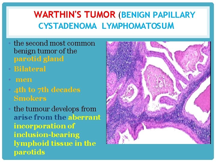 WARTHIN'S TUMOR (BENIGN PAPILLARY CYSTADENOMA LYMPHOMATOSUM • the second most common benign tumor of