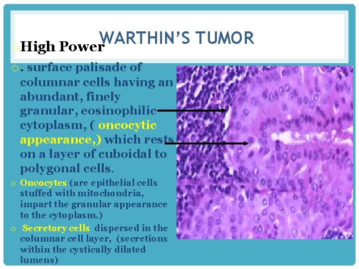 WARTHIN’S TUMOR o High Power o. surface palisade of columnar cells having an abundant,
