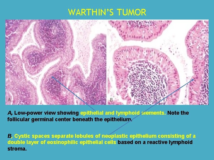 WARTHIN’S TUMOR A, Low-power view showing epithelial and lymphoid elements. Note the follicular germinal