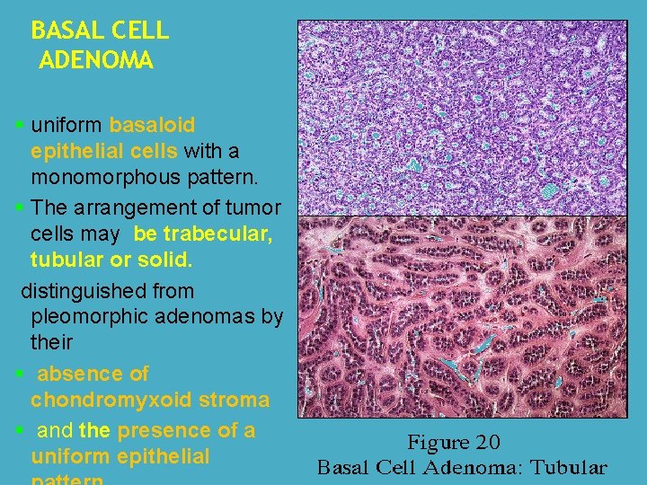 BASAL CELL ADENOMA § uniform basaloid epithelial cells with a monomorphous pattern. § The