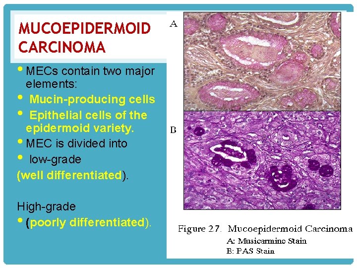 MUCOEPIDERMOID CARCINOMA • MECs contain two major elements: • Mucin-producing cells • Epithelial cells