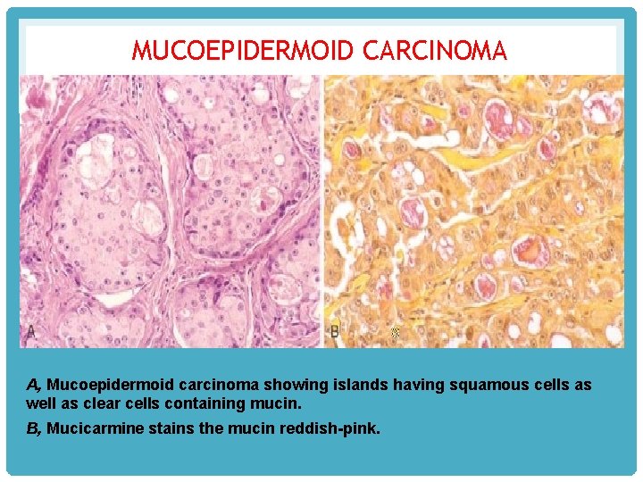 MUCOEPIDERMOID CARCINOMA A, Mucoepidermoid carcinoma showing islands having squamous cells as well as clear