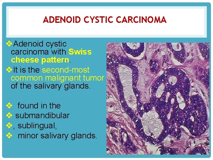 ADENOID CYSTIC CARCINOMA v. Adenoid cystic carcinoma with Swiss cheese pattern. v. It is