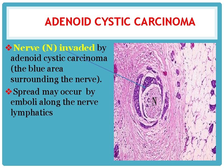 ADENOID CYSTIC CARCINOMA v. Nerve (N) invaded by adenoid cystic carcinoma (the blue area