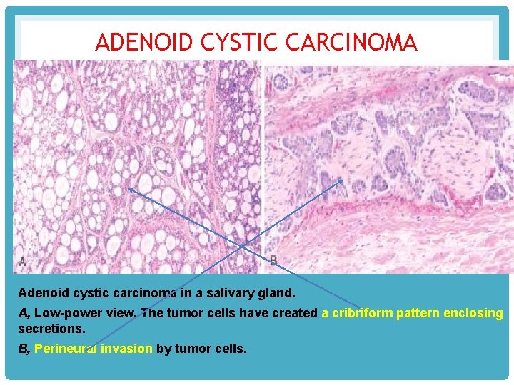 ADENOID CYSTIC CARCINOMA Adenoid cystic carcinoma in a salivary gland. A, Low-power view. The