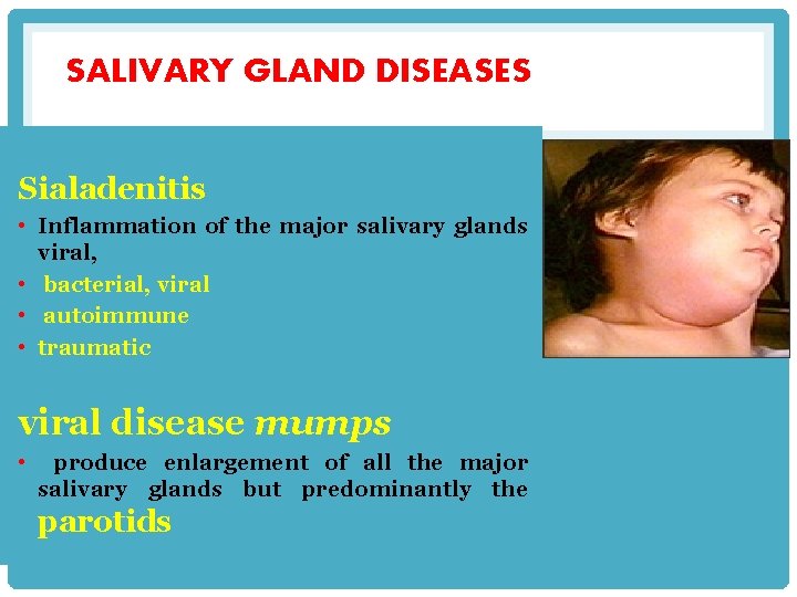 SALIVARY GLAND DISEASES Sialadenitis • Inflammation of the major salivary glands viral, • bacterial,