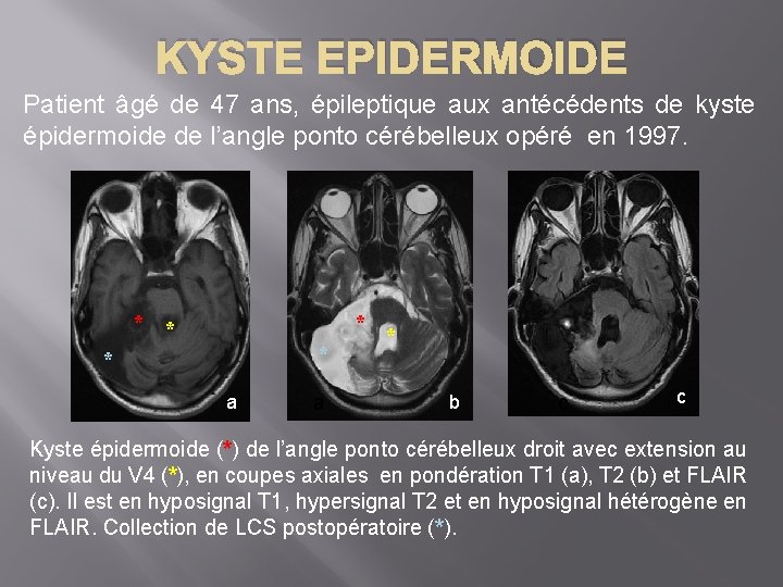 KYSTE EPIDERMOIDE Patient âgé de 47 ans, épileptique aux antécédents de kyste épidermoide de