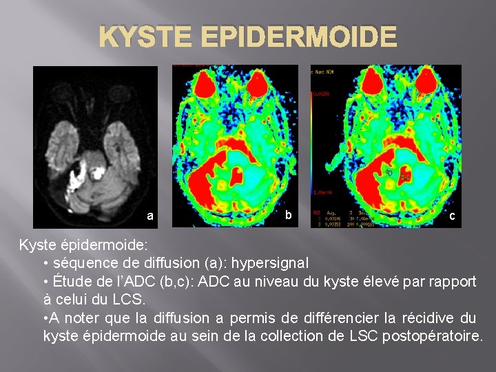 KYSTE EPIDERMOIDE a b c Kyste épidermoide: • séquence de diffusion (a): hypersignal •