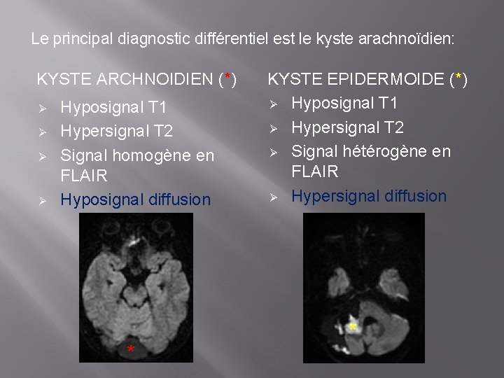 Le principal diagnostic différentiel est le kyste arachnoïdien: KYSTE ARCHNOIDIEN (*) Ø Ø Hyposignal