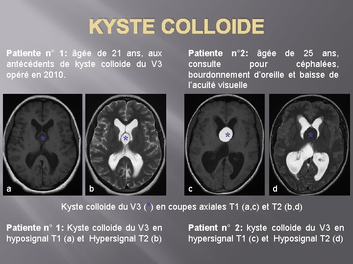 KYSTE COLLOIDE Patiente n° 1: âgée de 21 ans, aux antécédents de kyste colloide