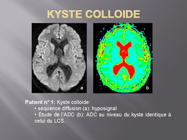 KYSTE COLLOIDE a b Patient n° 1: Kyste colloide: • séquence diffusion (a): hyposignal